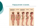 наруш осанки.jpg