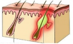 ФУРУНКУЛЕЗ