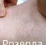 Розеола - Елецкая ГДБ