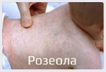 Розеола